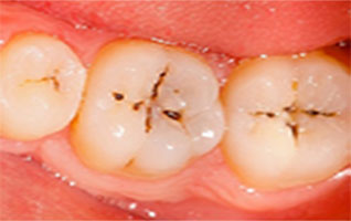 tooth-cavity